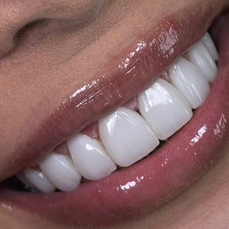Close de sorriso com lentes feitas pela Dra. Ana Beatriz