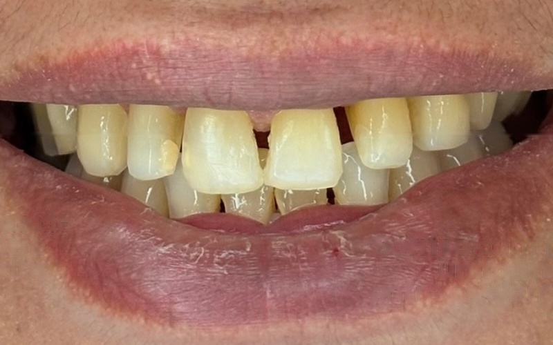 Antes: dentes com diferenças de tonalidade e formato