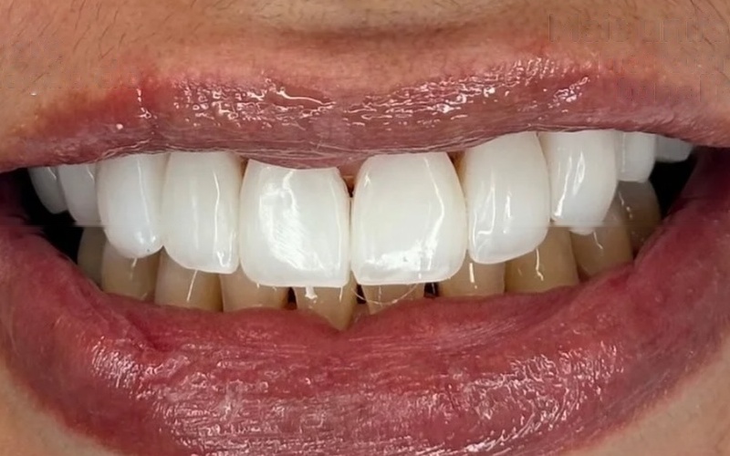 Depois: sorriso com facetas em resina, mais uniforme