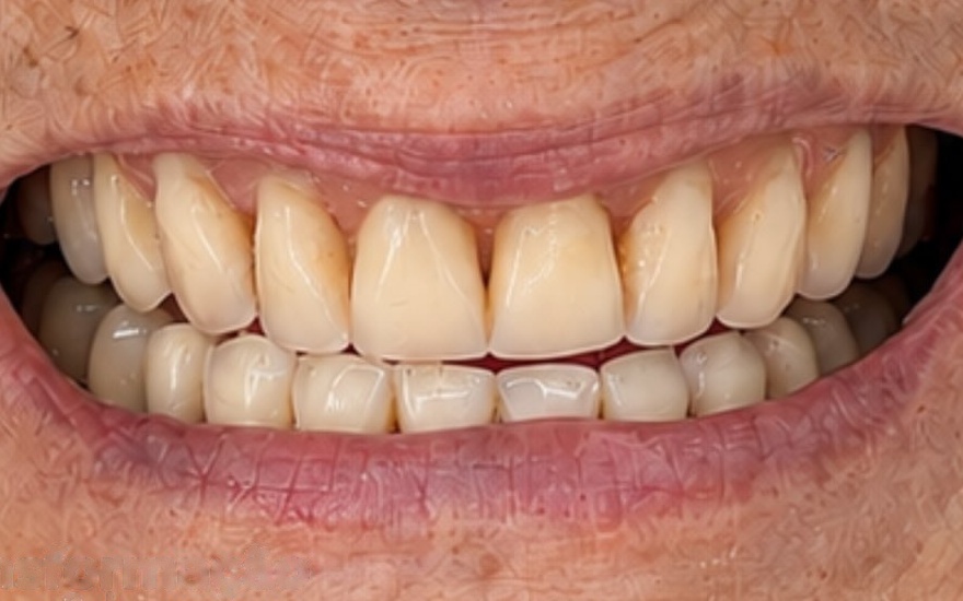 Antes: dentes desgastados e com manchas