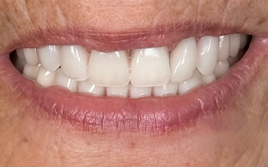 Depois: sorriso reabilitado com prótese dentária