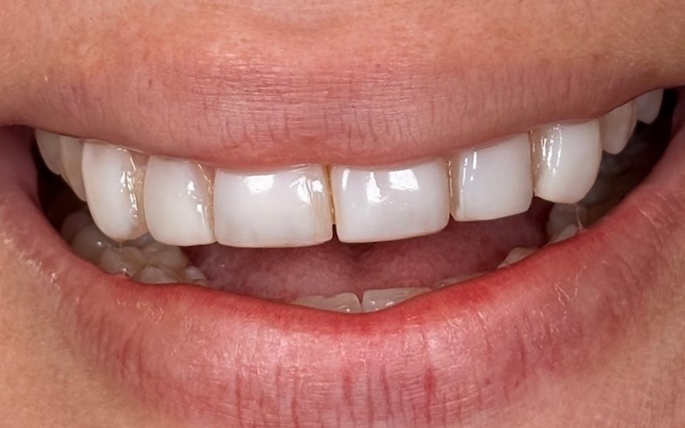 Antes: dentes da frente com bordas retas e formato pouco natural