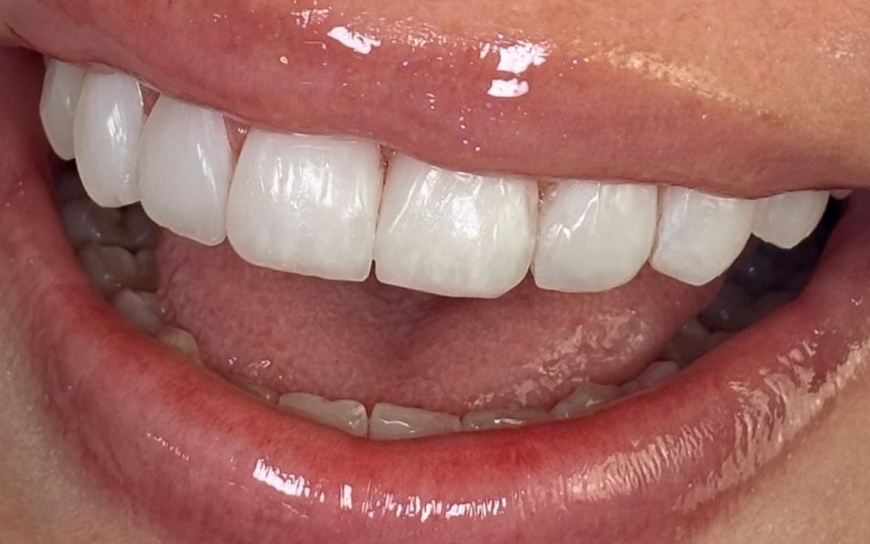 Depois: dentes com proporção e formato mais harmônicos
