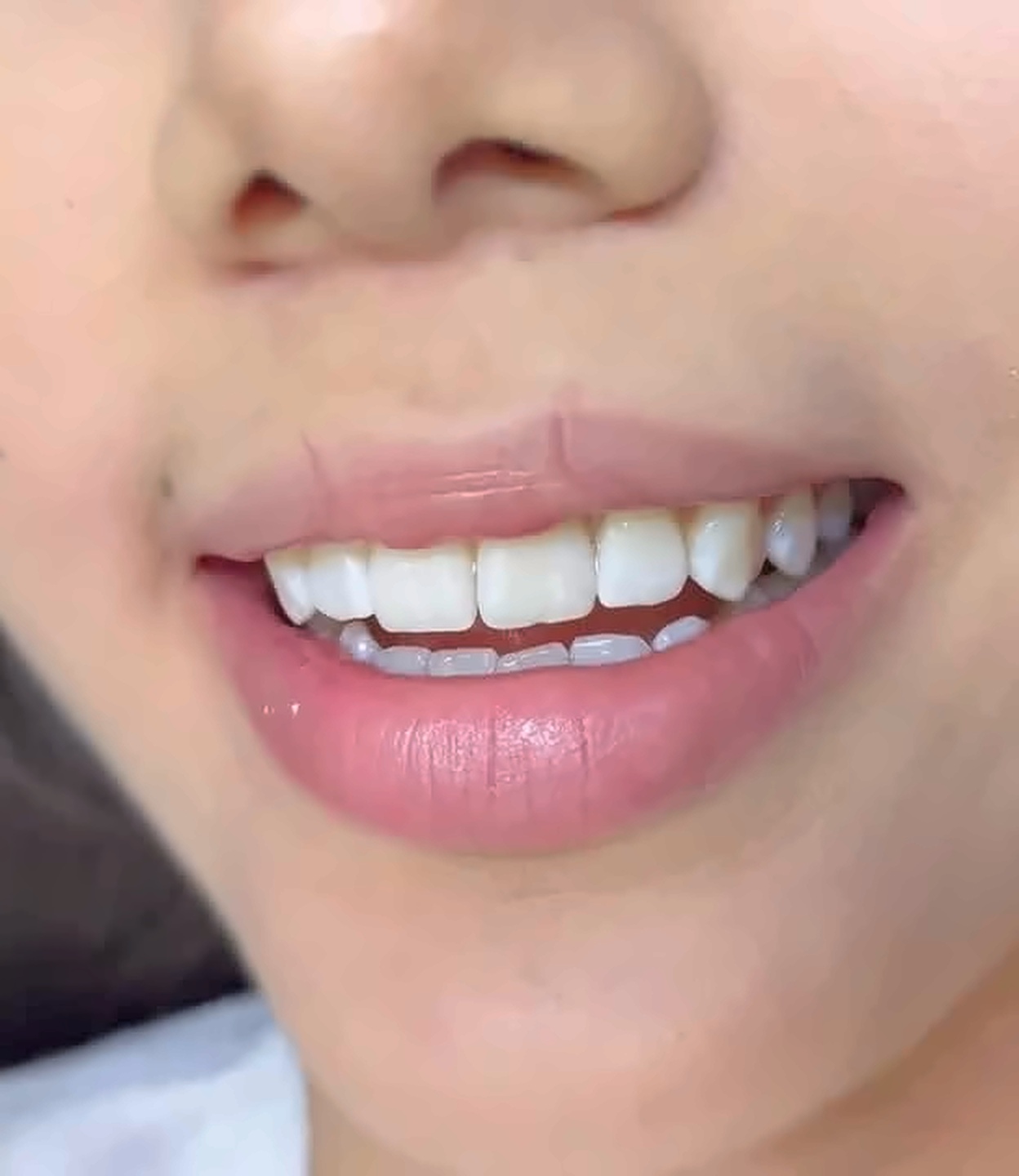 Sorriso de paciente após clareamento dental com a Dra. Ana Beatriz