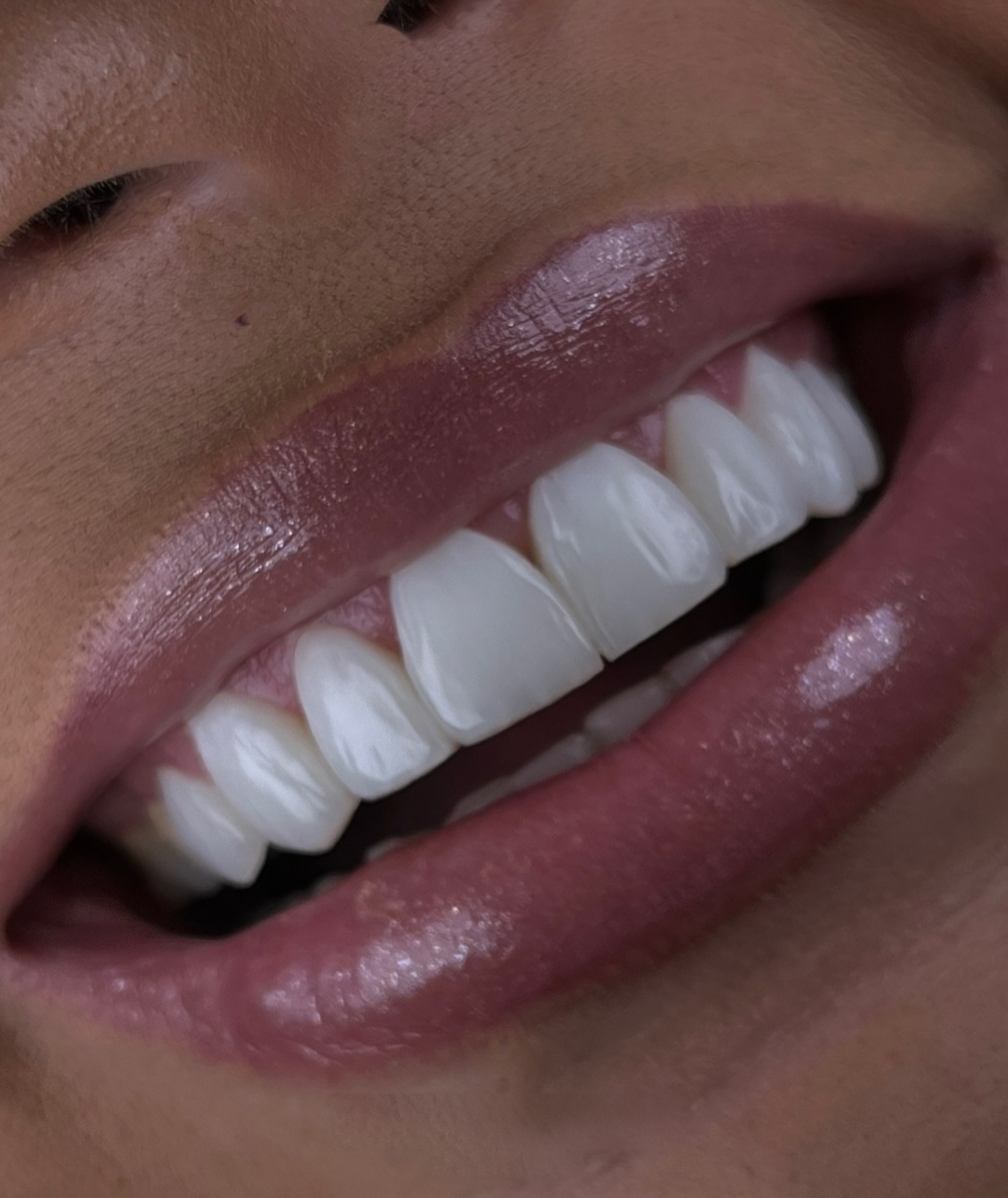 Close de sorriso com facetas feitas pela Dra. Ana Beatriz